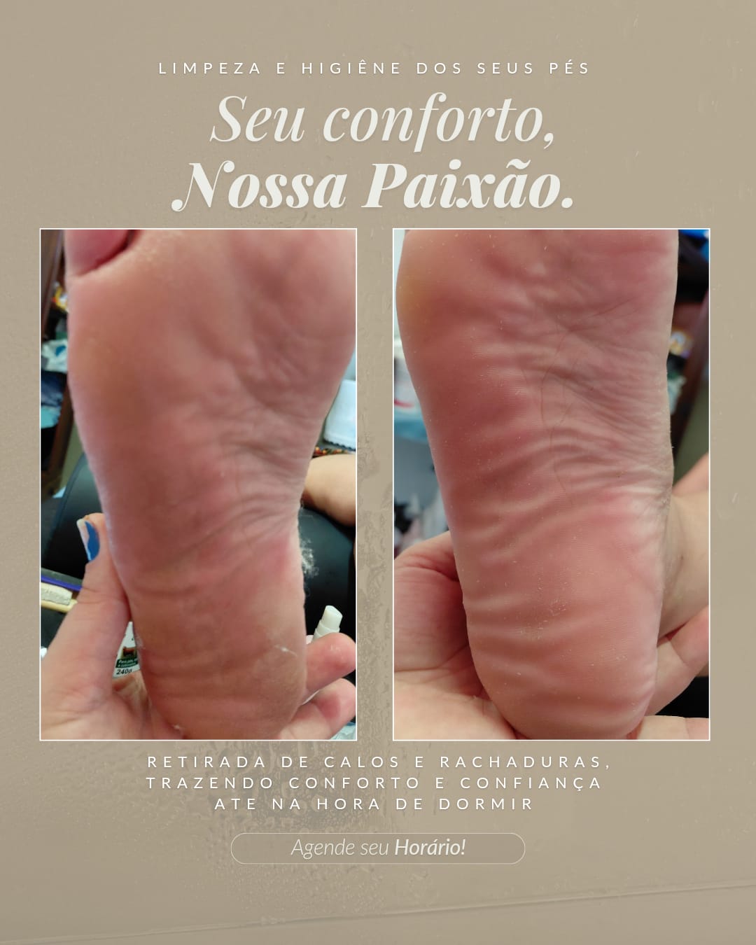 Remoção de Calos